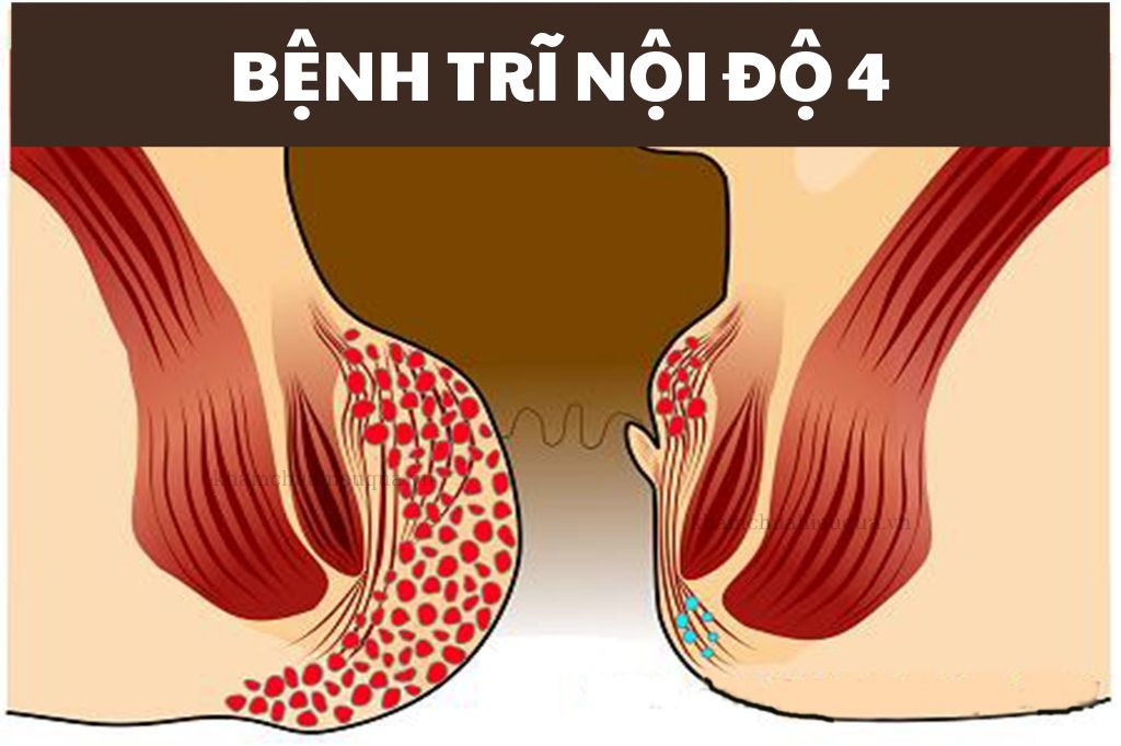 10 điều cần biết về Bệnh trĩ Nguyên nhân, triệu chứng, phát hiện, điều trị và phòng ngừa